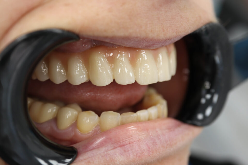 Установка 6-ти дентальных имплантантов Megagen Anyone