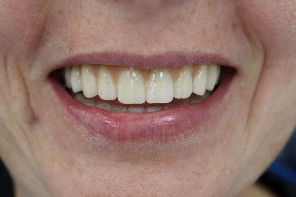 6-ти дентальных имплантантах Megagen Anyone