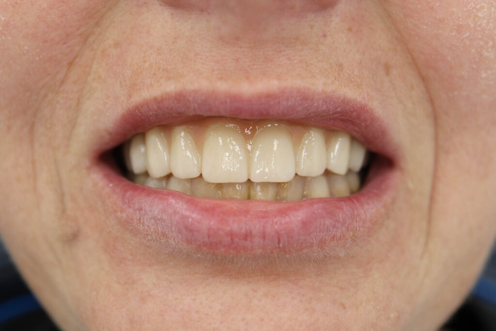 Установка 6-ти дентальных имплантантов Megagen Anyone