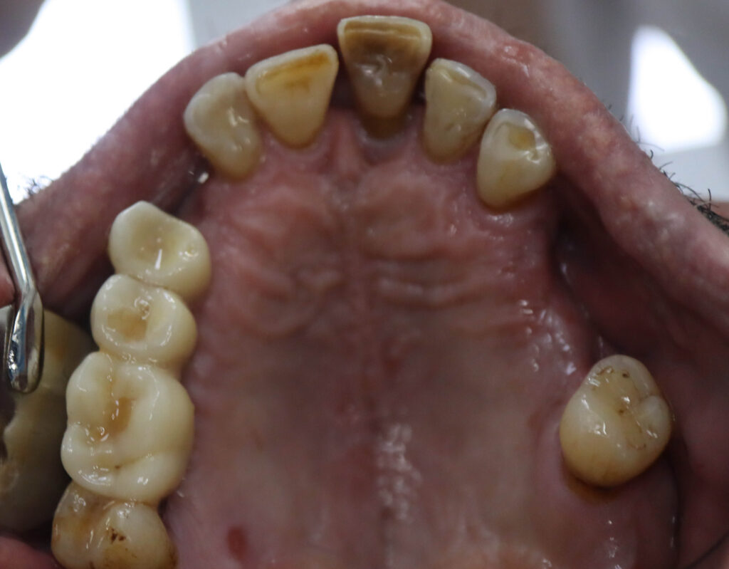 пациент до имплантации