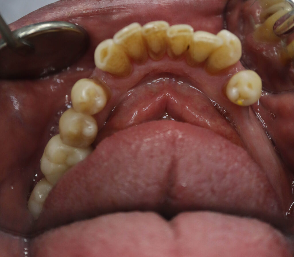 пациент до имплантации