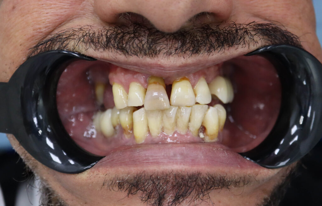 пациент до имплантации