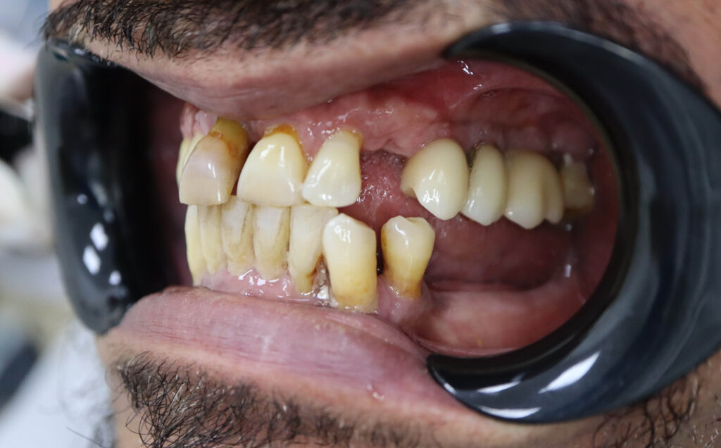 пациент до имплантации