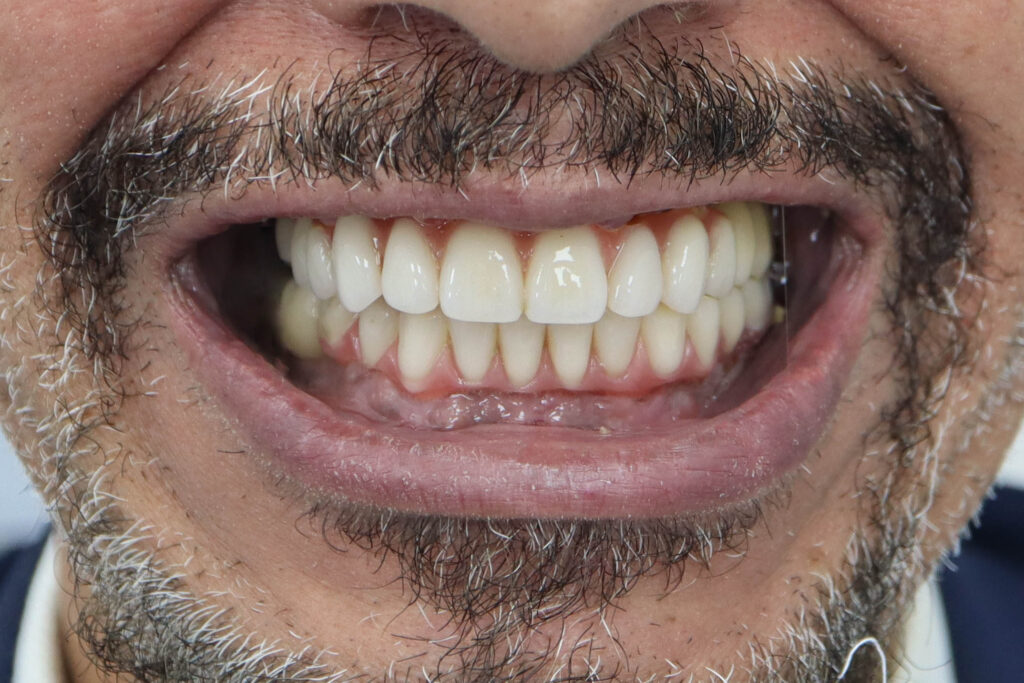 5 имплантатов Megagen AnyOne