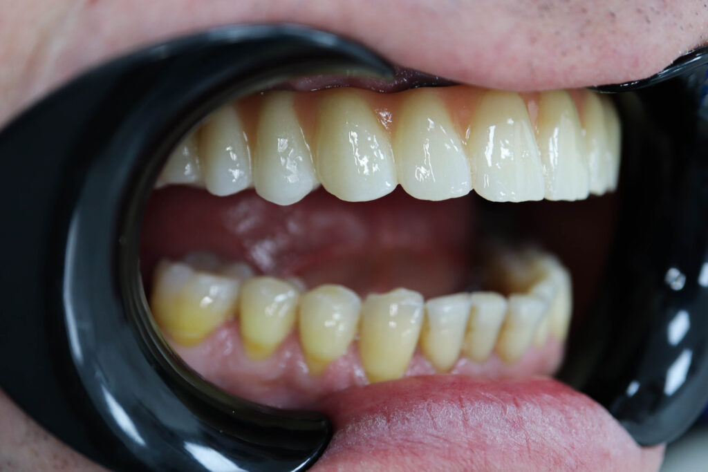 результат имплантации SimplaDent