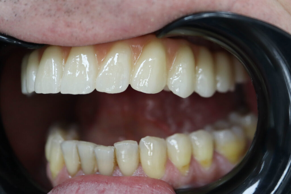 результат имплантации SimplaDent