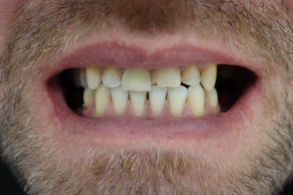 Ситуация до лечения Бутримович