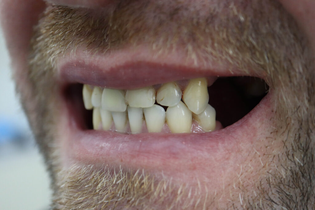 Ситуация до лечения Бутримович