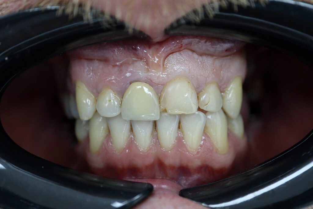 Ситуация до лечения Бутримович