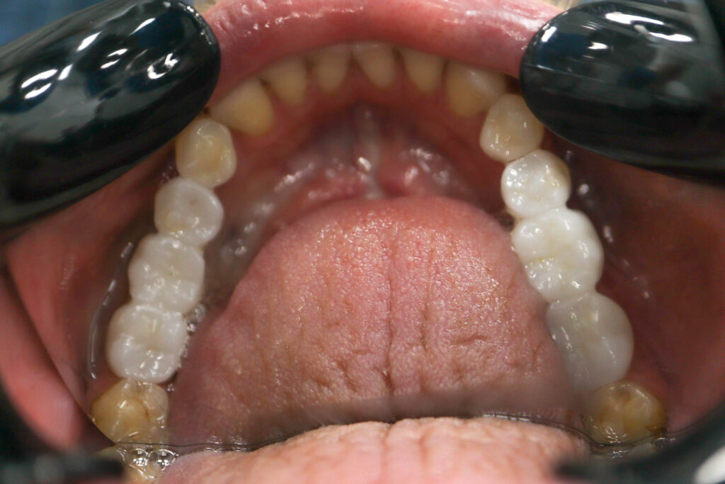 Результат протезирования и имплантации