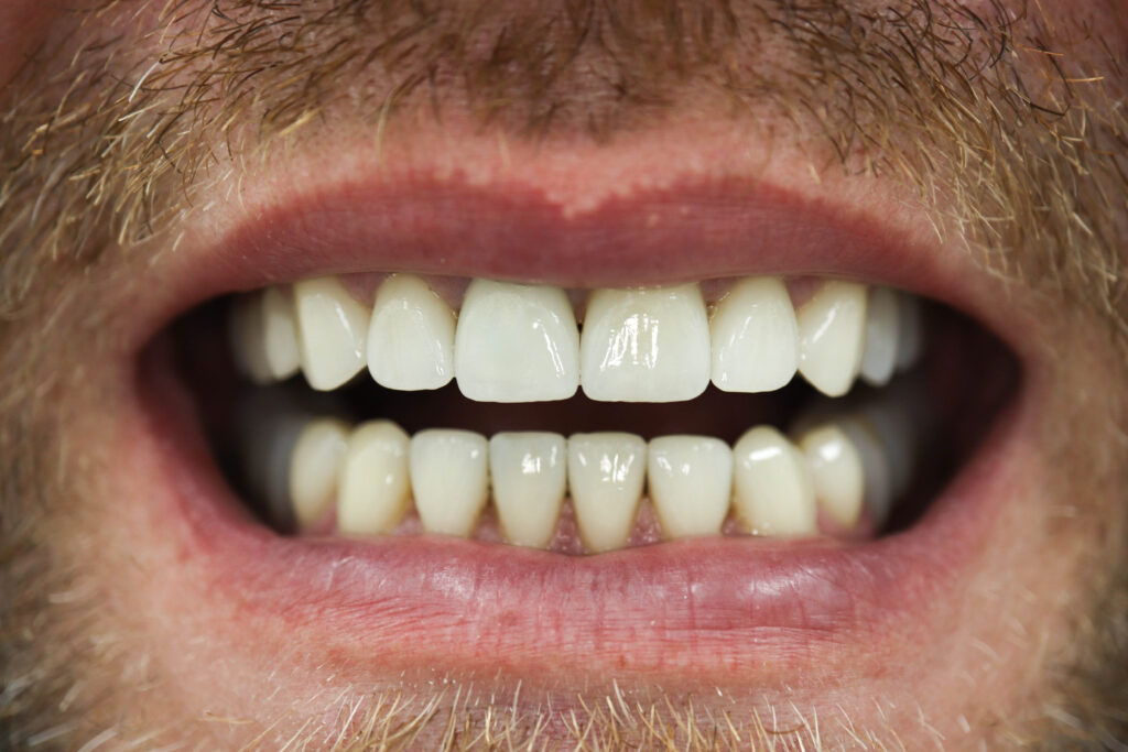 Имплантация Megagen Anyone + установка керамических виниров и коронок