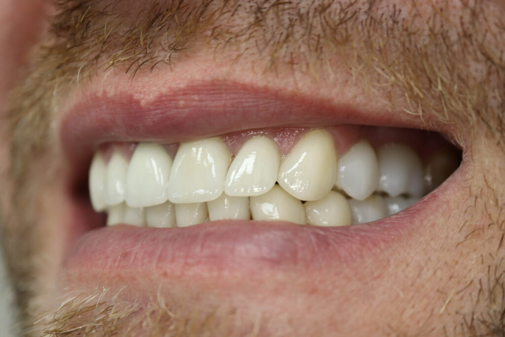 Результат протезирования и имплантации