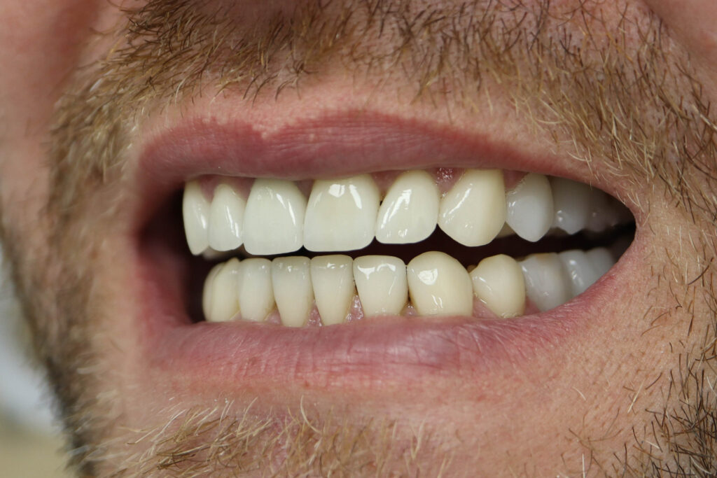 Результат протезирования и имплантации