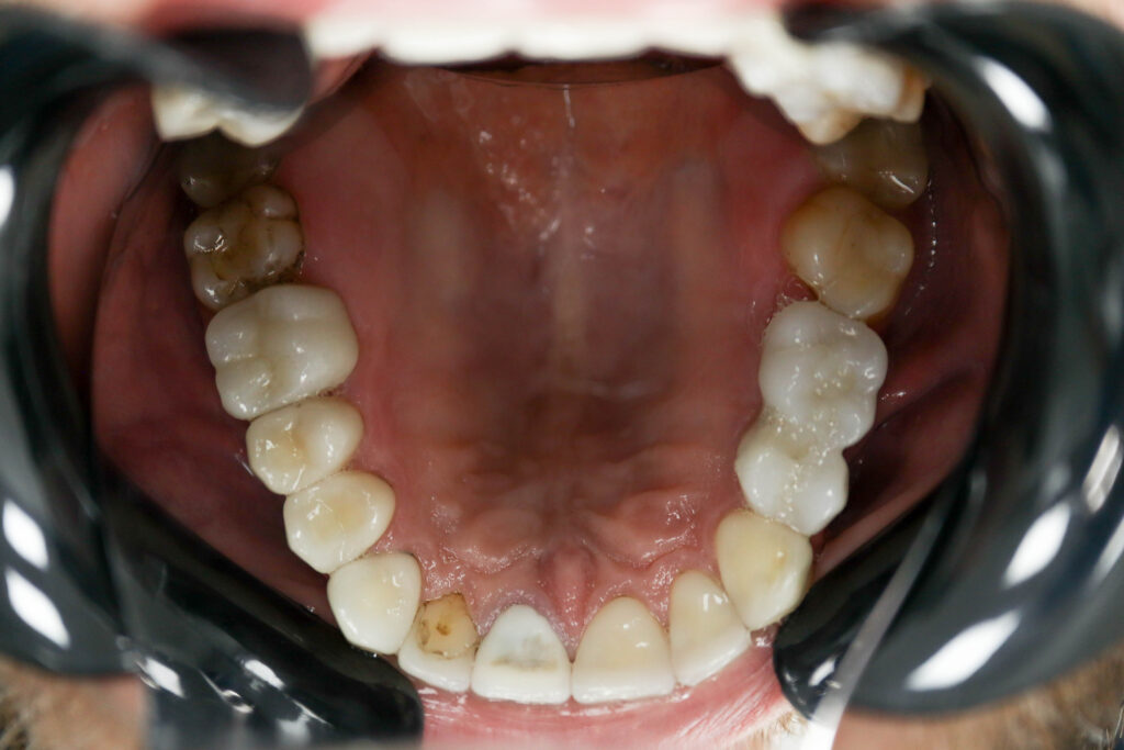 Результат протезирования и имплантации