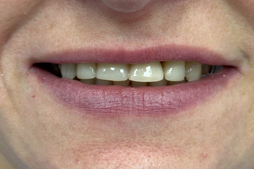 Реставрации Emax Press цвета A1 ДО