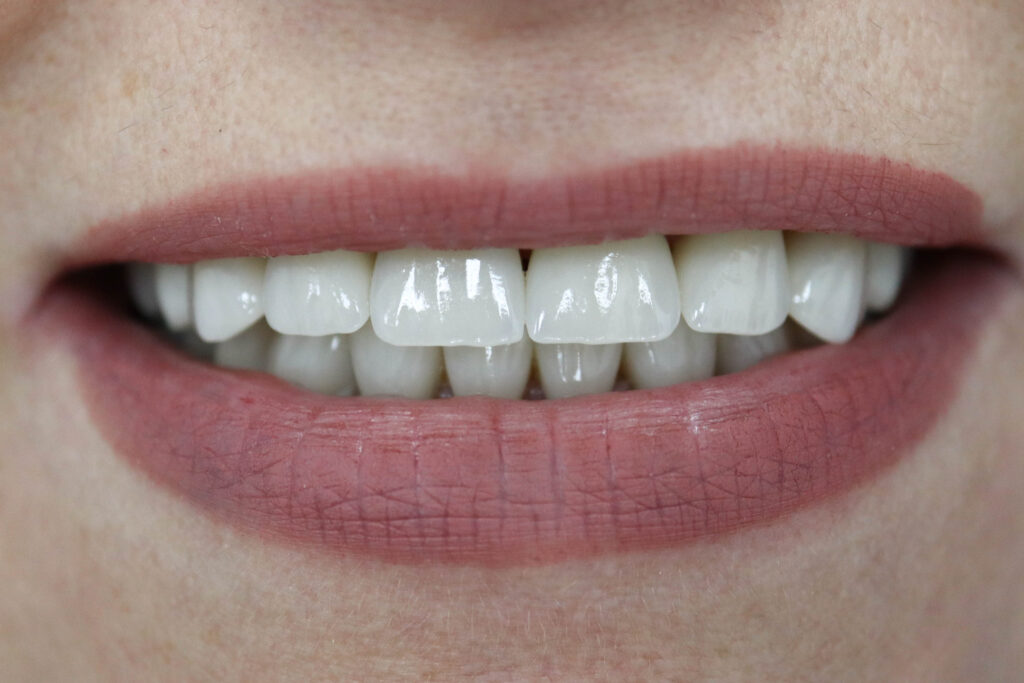 Реставрации Emax Press цвета A1 После