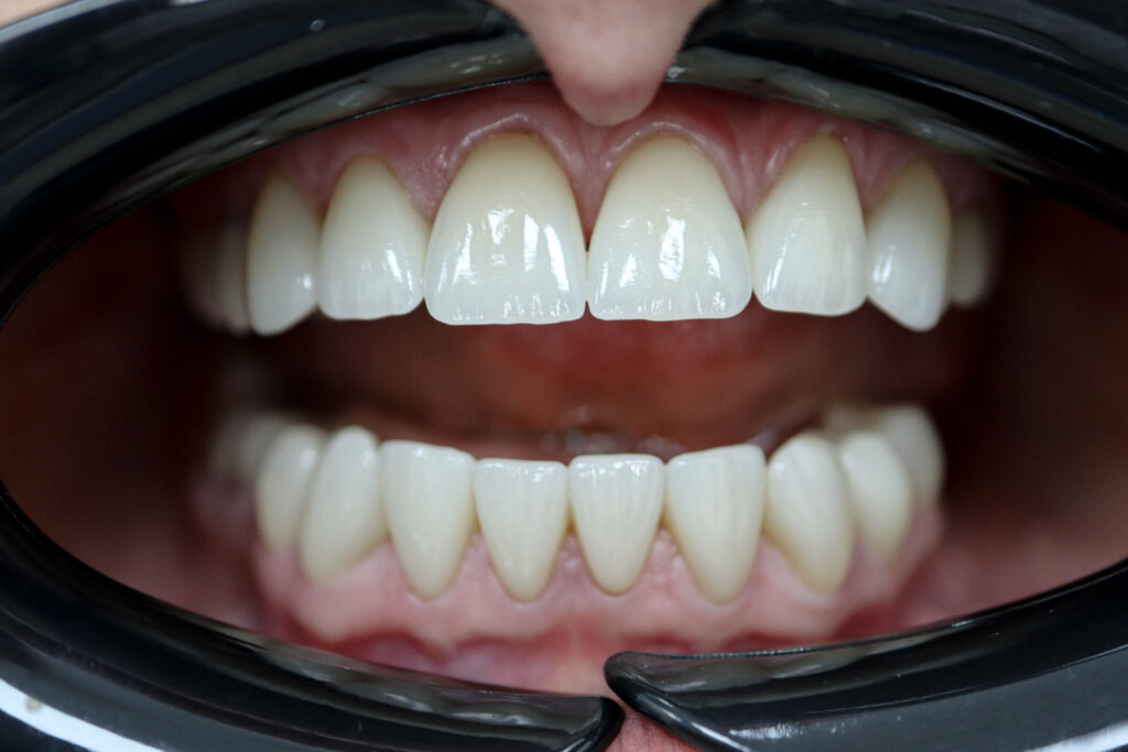 Реставрации Emax Press цвета A1 После