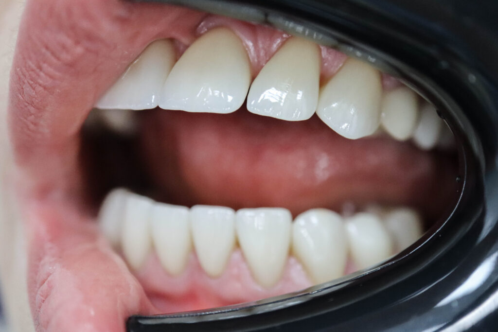 Реставрации Emax Press цвета A1 После