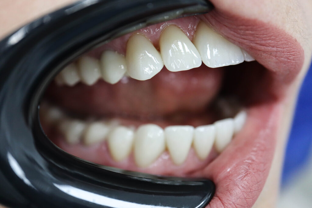 Реставрации Emax Press цвета A1 После