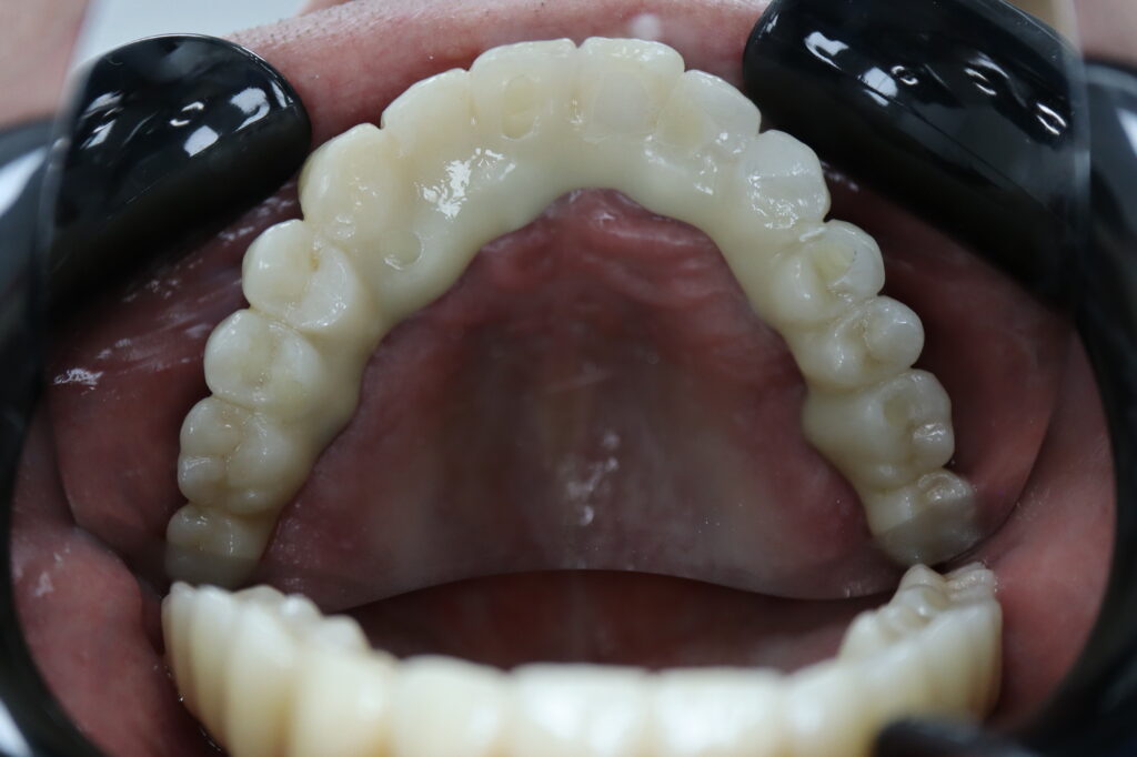 результат имплантации SimplaDent