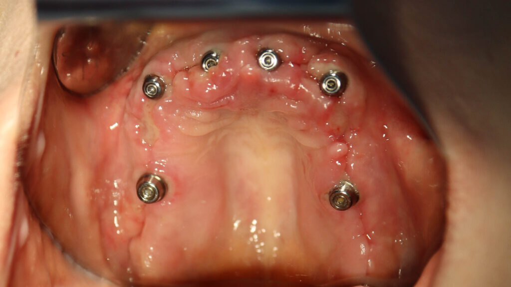 процесс имплантации
