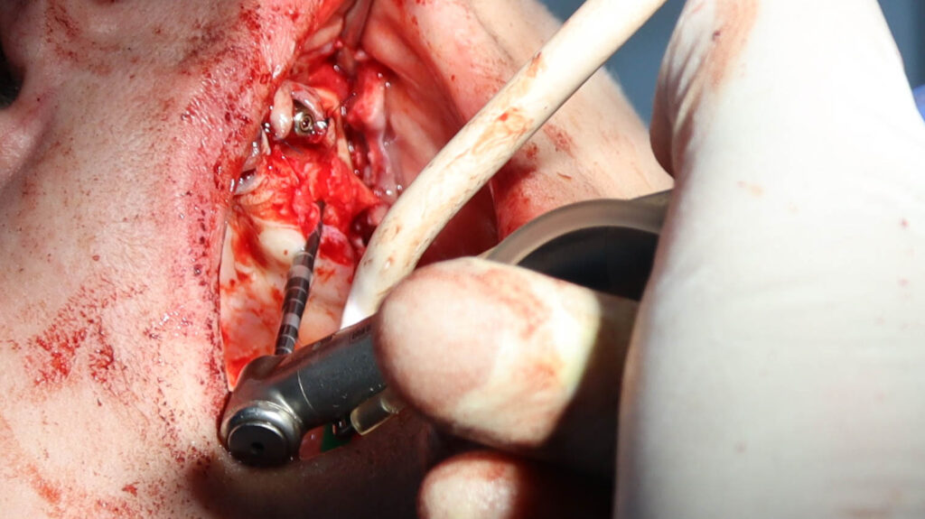 процесс имплантации