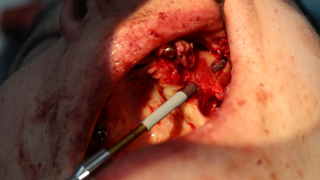 процесс имплантации