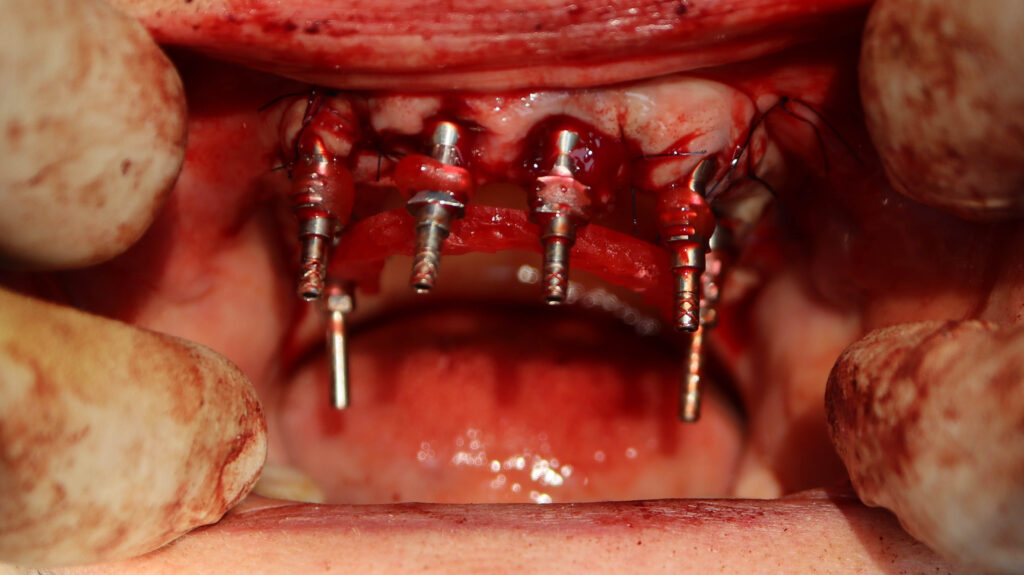 процесс имплантации