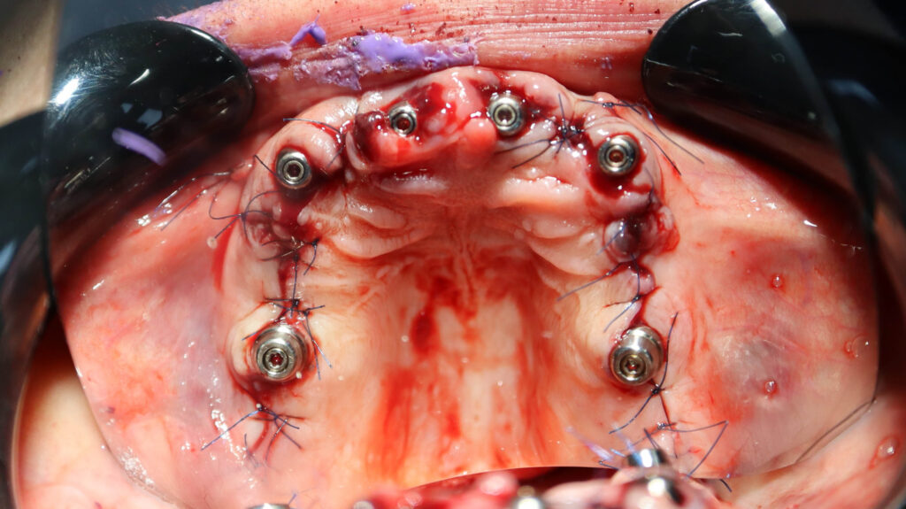 процесс имплантации