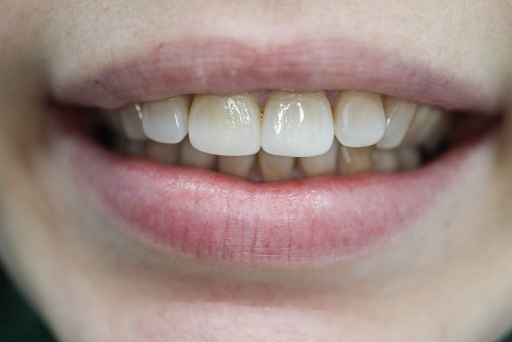 результат протезирования