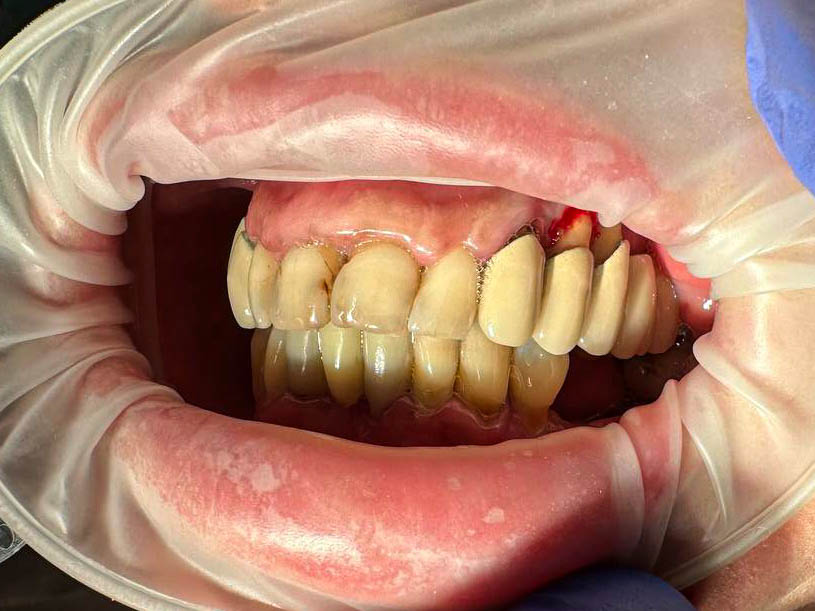 пациент до имплантации