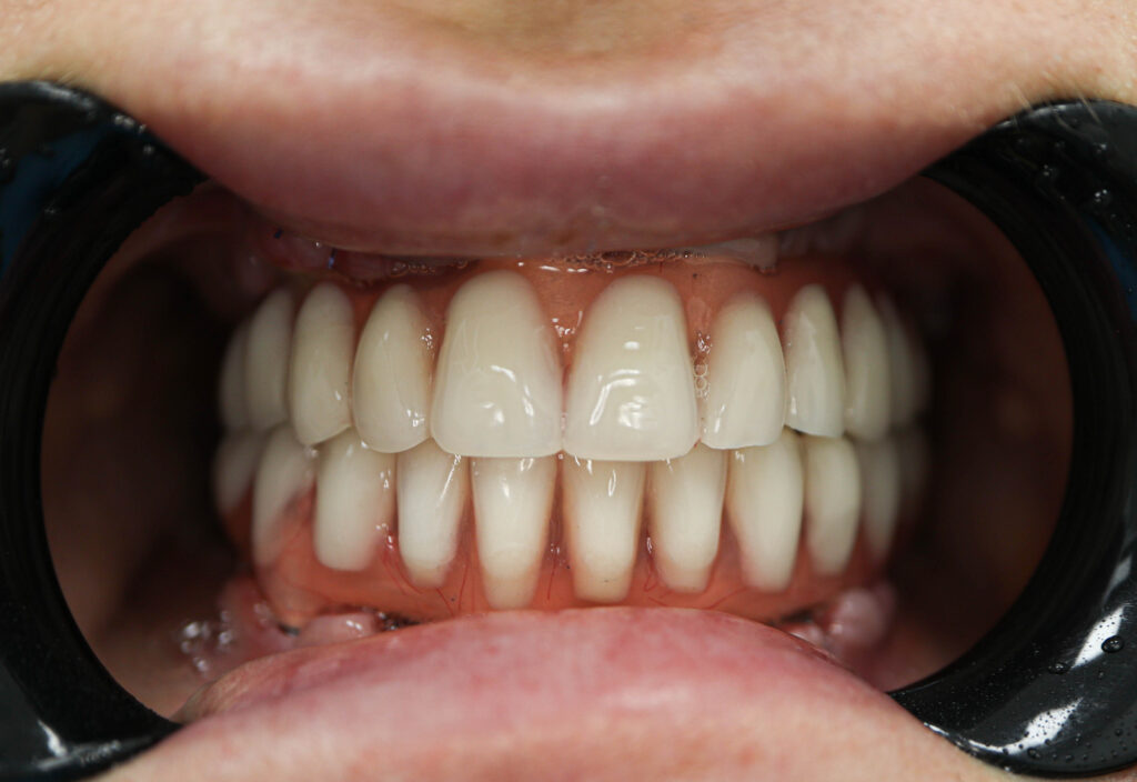 Установка 6 классических имплантатов NeoDent и 3 скуловых имплантата