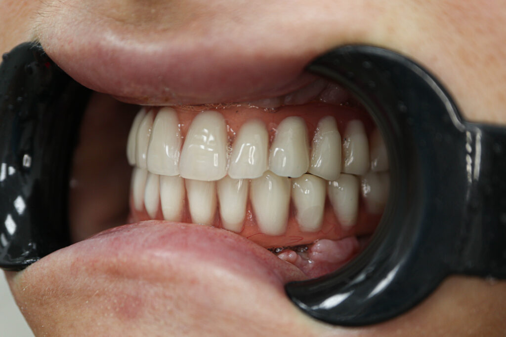 Установка 6 классических имплантатов NeoDent и 3 скуловых имплантата