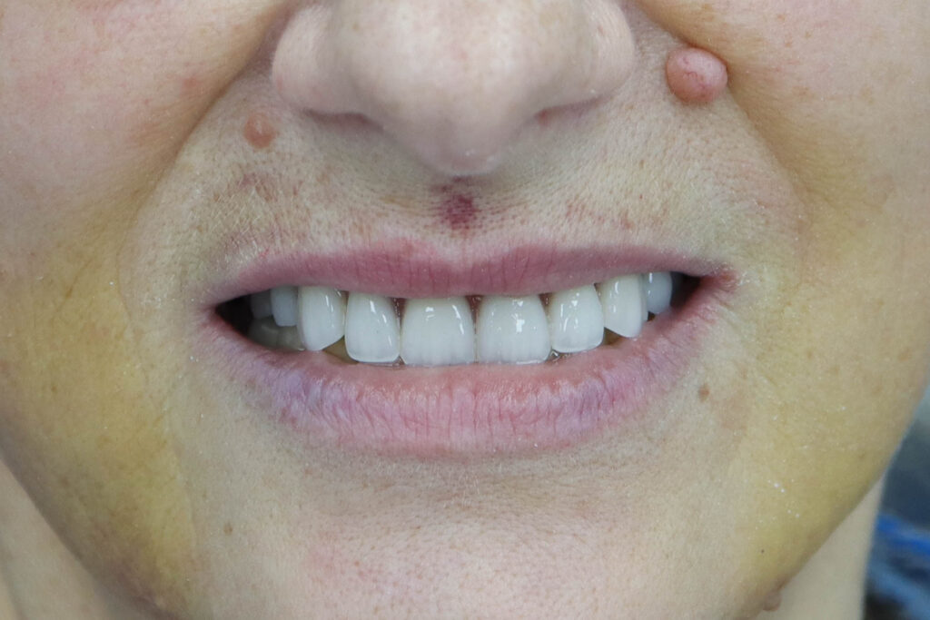 результат имплантации