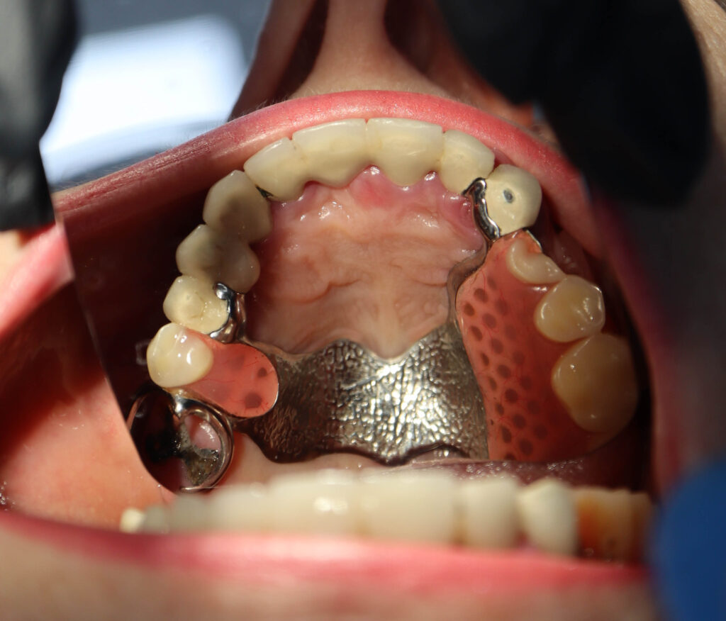 процесс имплантации