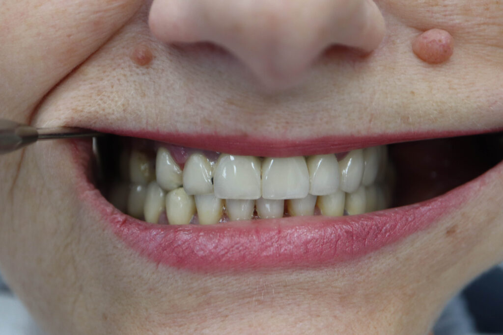 процесс имплантации