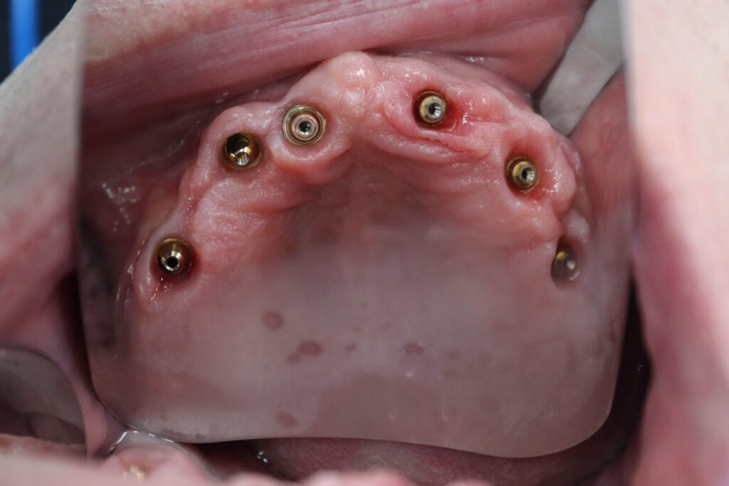 процесс имплантации