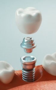 Имплантация Osstem