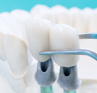 Двухэтапная имплантация зубов