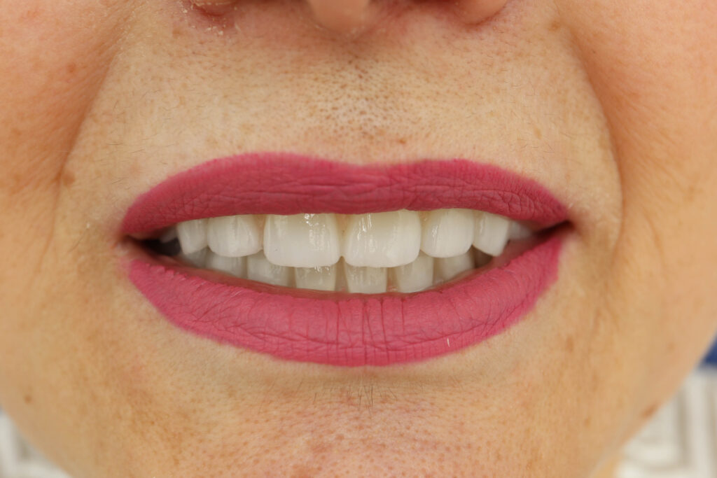  установки временных металлоакриловых протезов