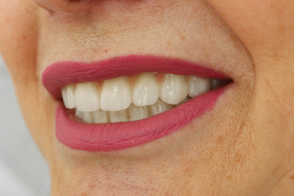 результат установки временных металлоакриловых протезов 