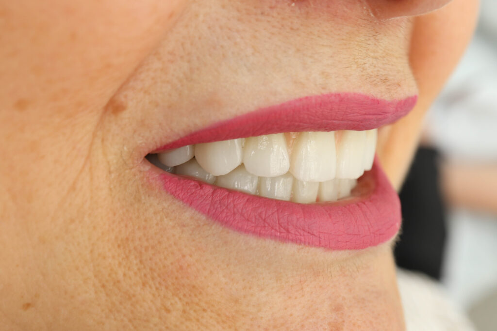 результат установки временных металлоакриловых протезов 