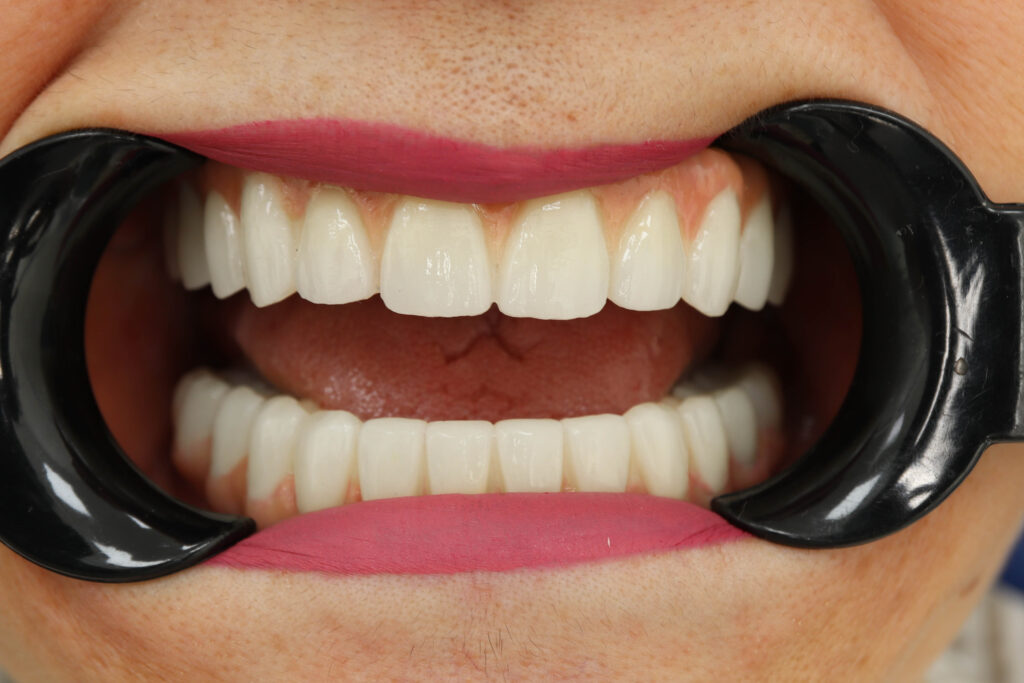 результат установки временных металлоакриловых протезов 