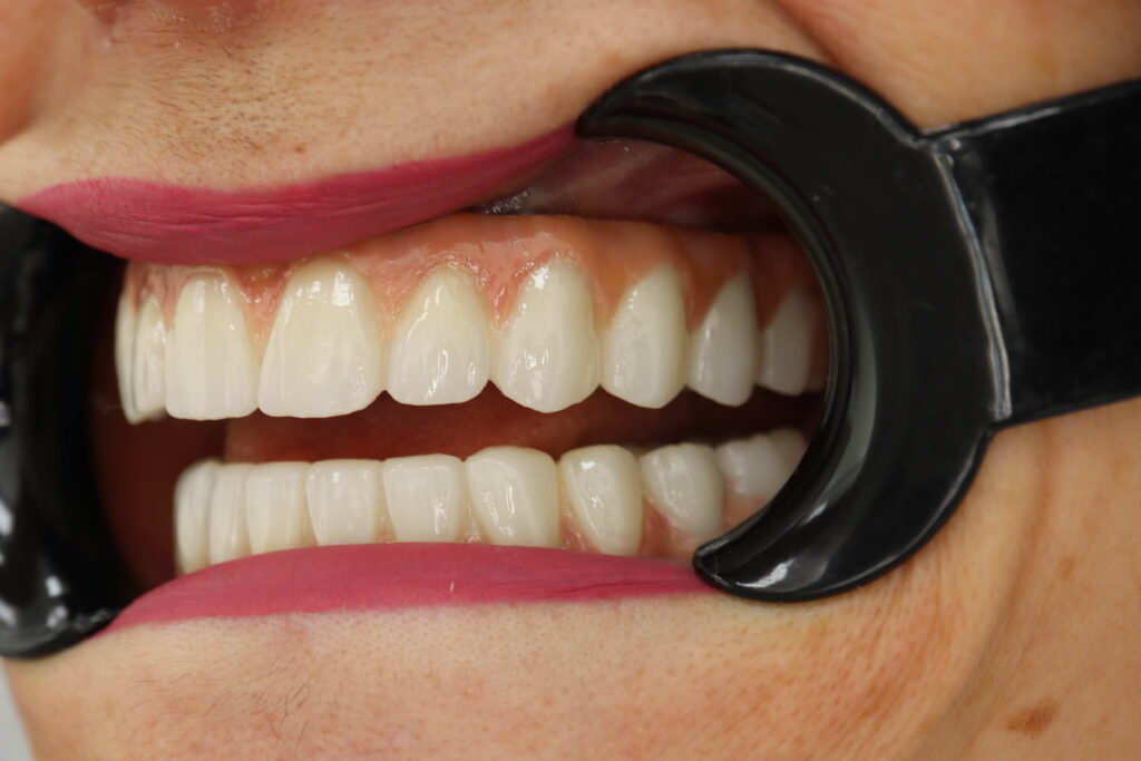 результат установки временных металлоакриловых протезов 