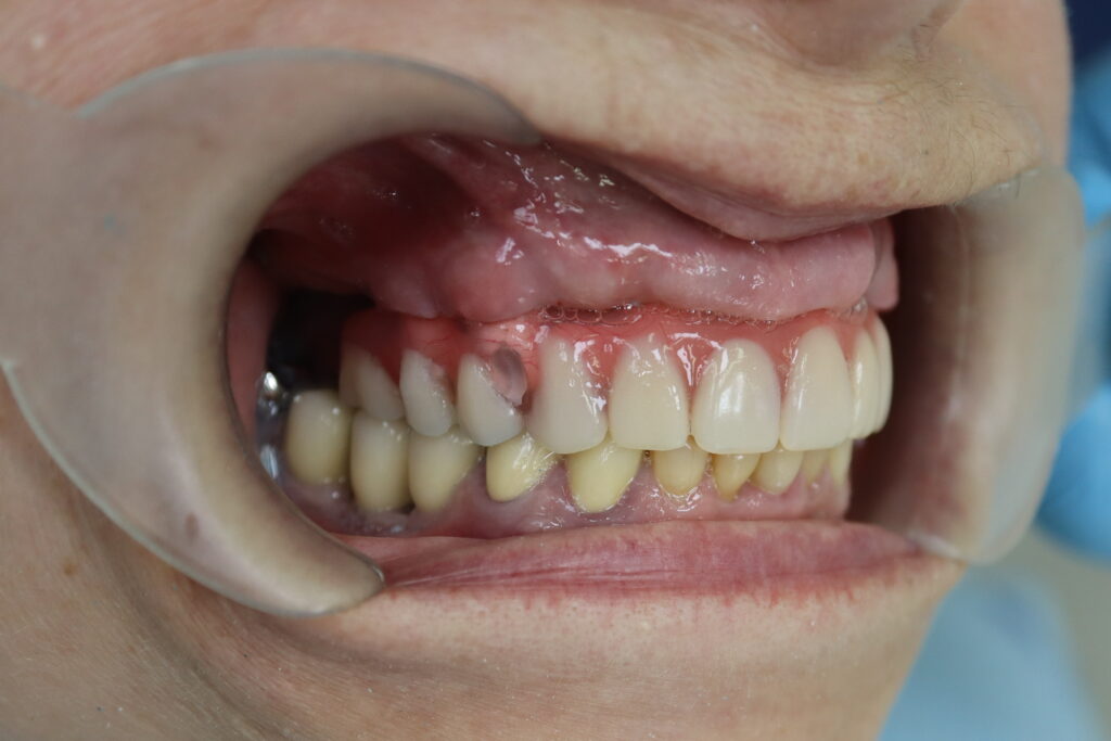 результат имплантации