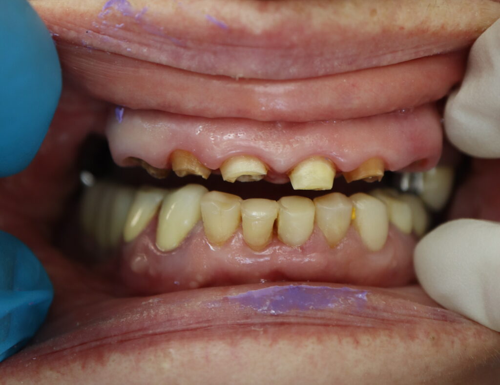 пациент до имплантации