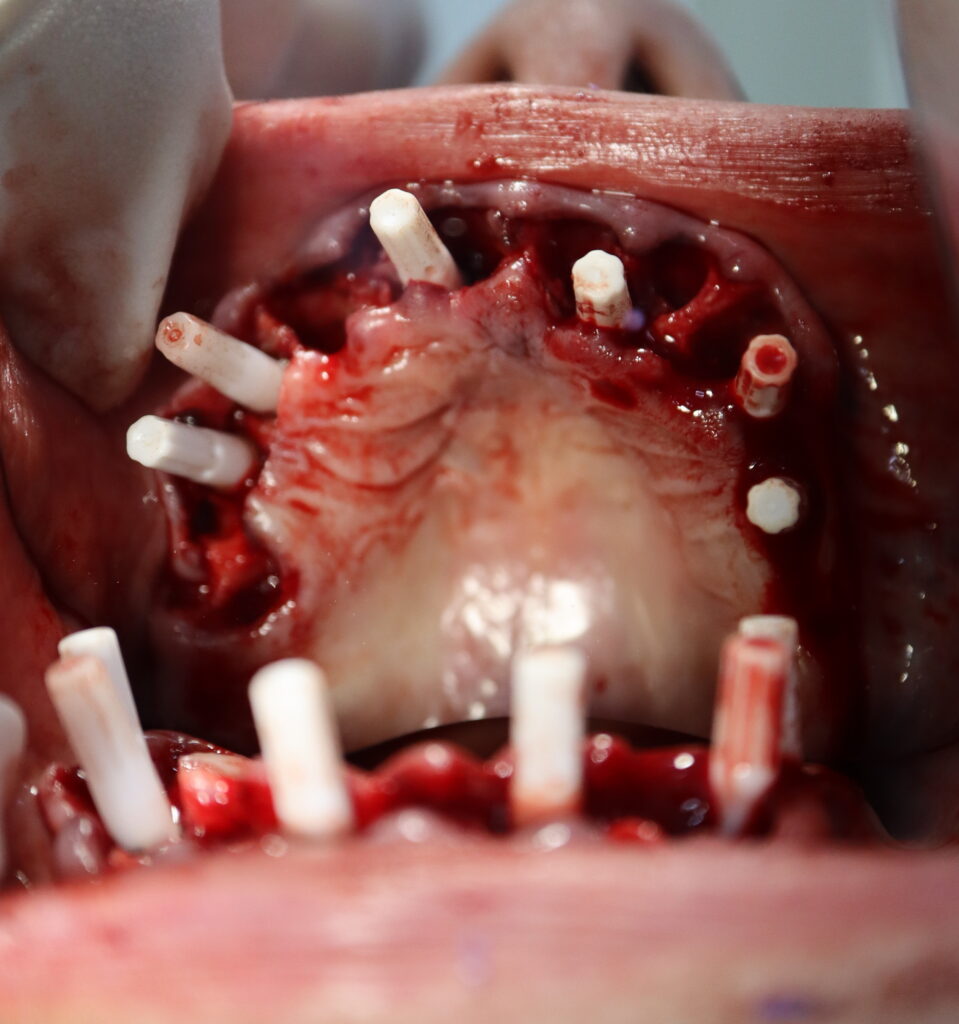 процесс имплантации