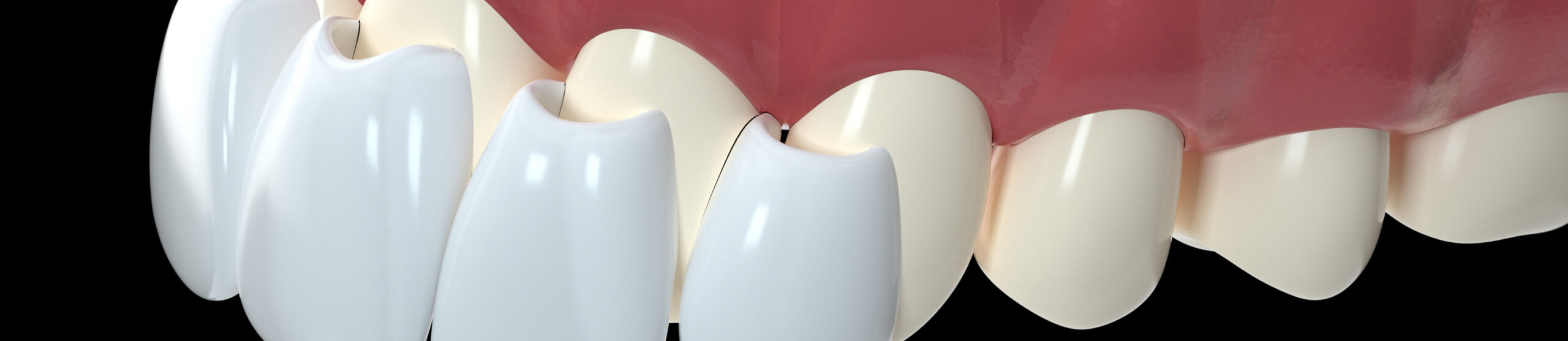 Виды керамических виниров