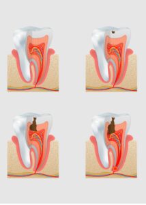 Лечение пульпита