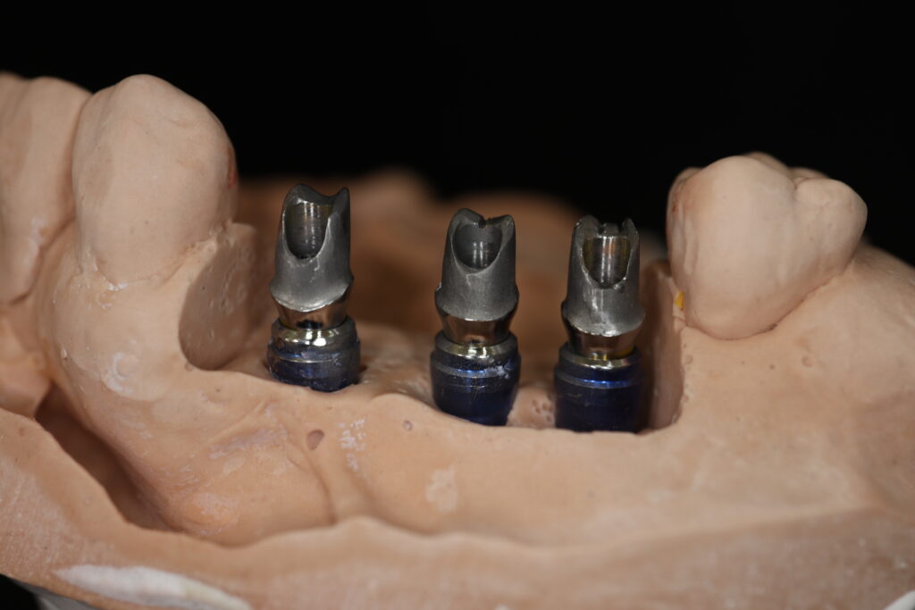 циркониевые протезы Cимпладент